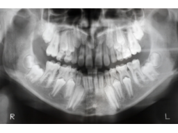 Webinar: Dentales Röntgen(1-2): Fehlervermeidung durch Fehleranalyse