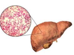 Ausbildung HEB / Gesundheitsberater*in, Block 8 Leber, -erkrankungen, Diätetik